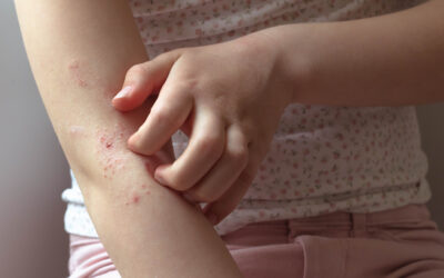 6 ways to protect your child from eczema
